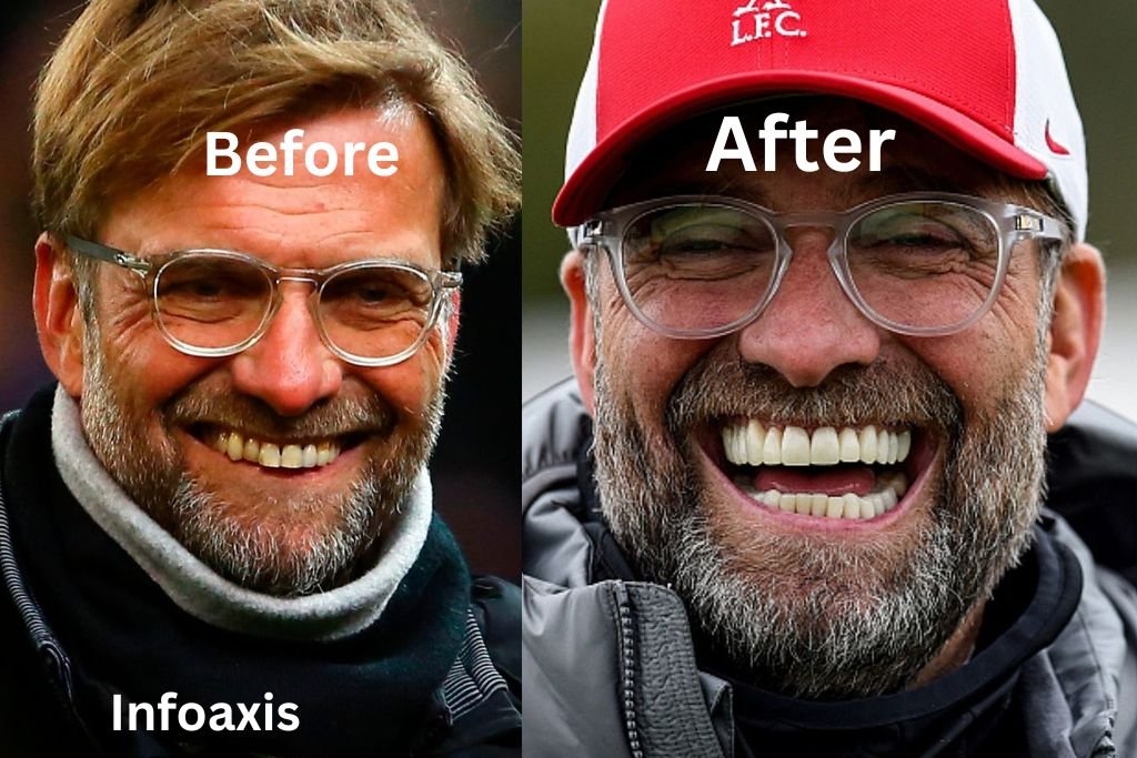 Jürgen Klopp Teeth